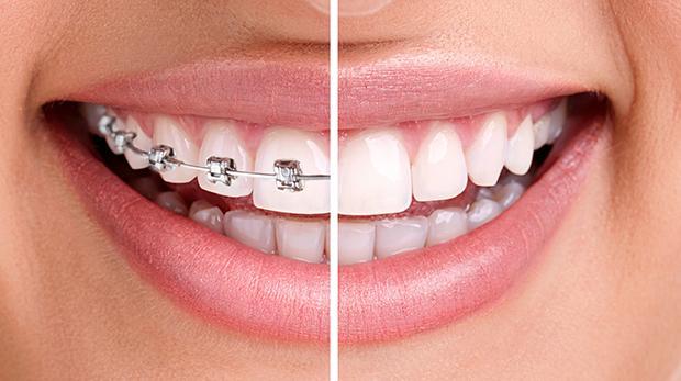 Dental Braces Guide, Treatment, Procedure and Cost