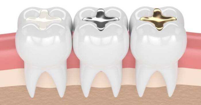 dental filling cost procedure and types