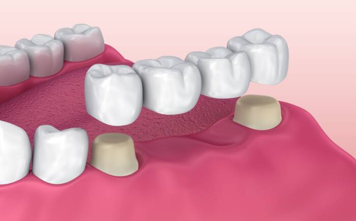 Dental bridge cost types and procedure