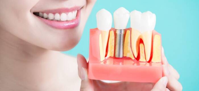 Dental implant types, cost and procedure guide