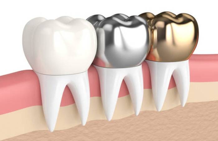 dental crowns guide