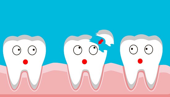 Teeth Bonding Costs, Procedure, Advantages, Disadvantages