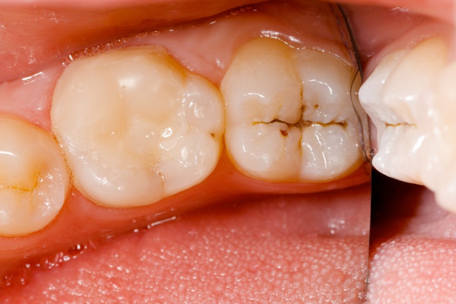 Molar teeth infection