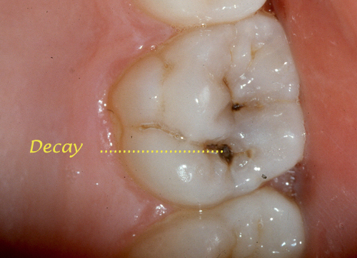 caries in tooth grooves