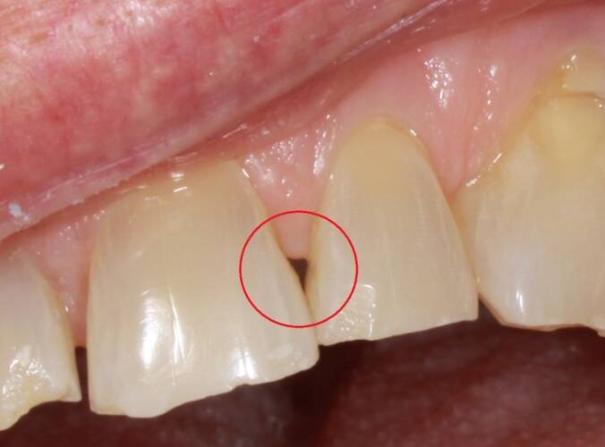 dental cavity forming between teeth