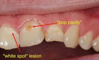 pop cavities