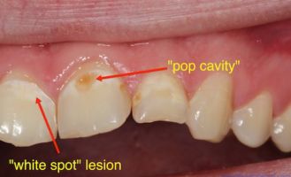 how to fill a cavity on front tooth