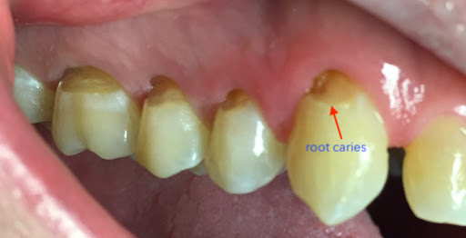 root caries