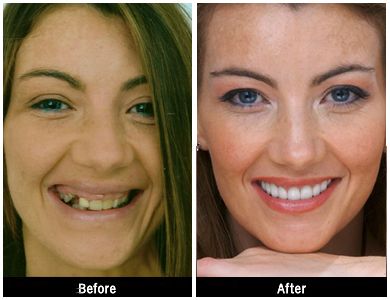 women before and after implant